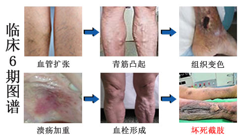 静脉曲张手术价格