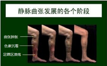 下肢静脉曲张