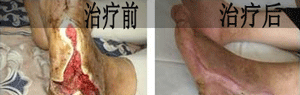 昆明治疗糖尿病足好的医院