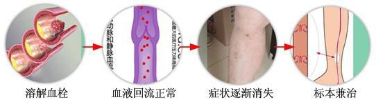 昆明三一一医院如何治疗静脉血栓