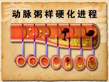 影动脉硬化闭塞症的发病因素有哪些