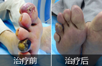 动脉硬化治疗方法