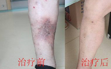 腿部静脉血栓好治吗