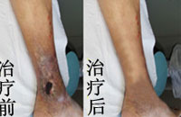 如何治疗与护理流产后的静脉炎疾病
