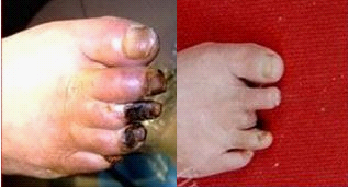 脉管炎疾病的危害有哪些？