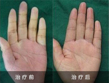 手脚冰冷脚底爱出汗 要查雷诺氏病