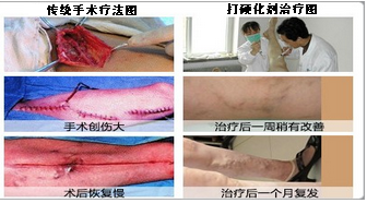 静脉曲张会遗传吗 应如何治疗