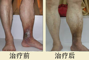 老烂腿怎么治?昆明三一一医院有绝招