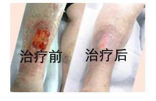 静脉炎的主要症状及有效治疗方法