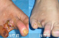 脉管炎由什么引起的？