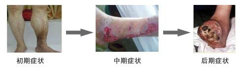 老烂腿在临床上的分期