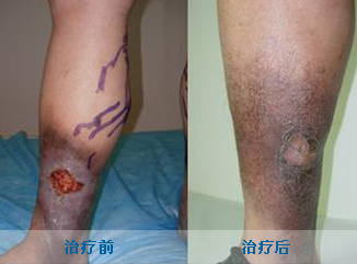 老烂腿的治疗方法