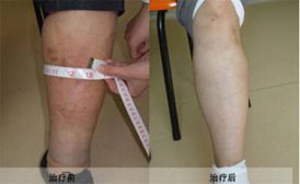 静脉血栓可以治疗吗?答案是肯定的