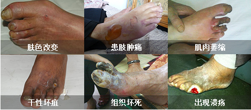 下肢动脉硬化的危害