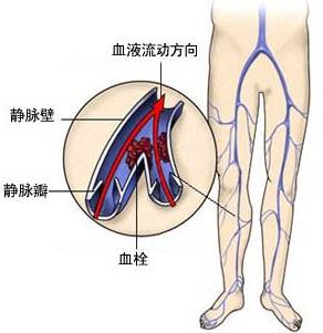 下肢静脉血栓需要做哪些检查