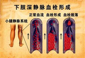 静脉血栓如何确诊