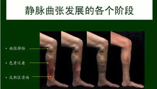 昆明三一一医院静脉曲张科
