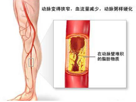 老年人怎么预防动脉硬化？
