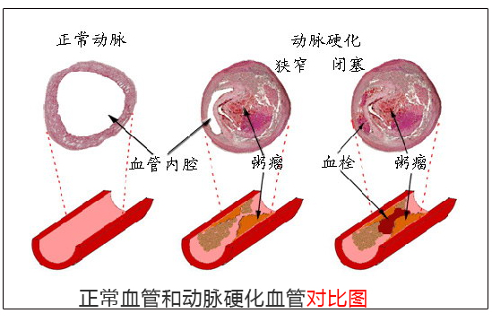 动脉硬化应该如何治疗？