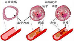 动脉硬化会对人体造成什么危害