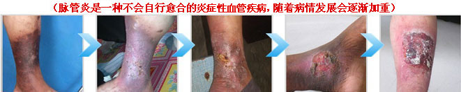 下肢出现红肿发热是怎回事