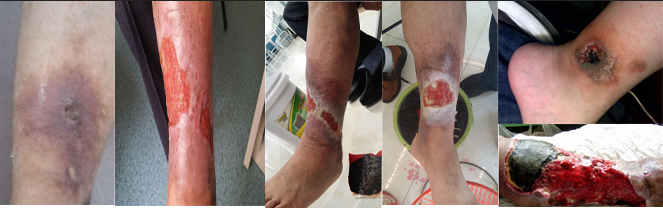 警惕老烂腿癌变，应尽早治疗