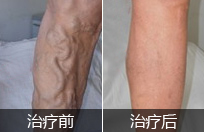 昆明治疗静脉曲张需要多少钱