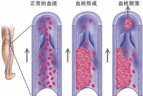 静脉血栓是怎么形成的