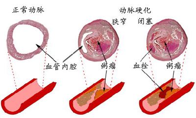 双下肢粥样动脉硬化怎么办?