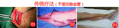 脉管炎最新治疗方法-昆明哪家医院可以治疗
