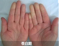 雷诺氏症的症状是什么？昆明哪里治疗费用合理？