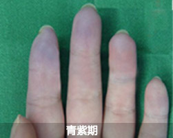 雷诺氏症的症状是什么？昆明哪里治疗费用合理？