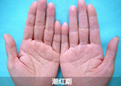 雷诺氏症的症状是什么？昆明哪里治疗费用合理？
