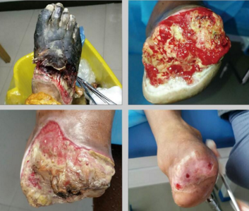 糖尿病足治疗费用是多少？如何治省时更省钱？